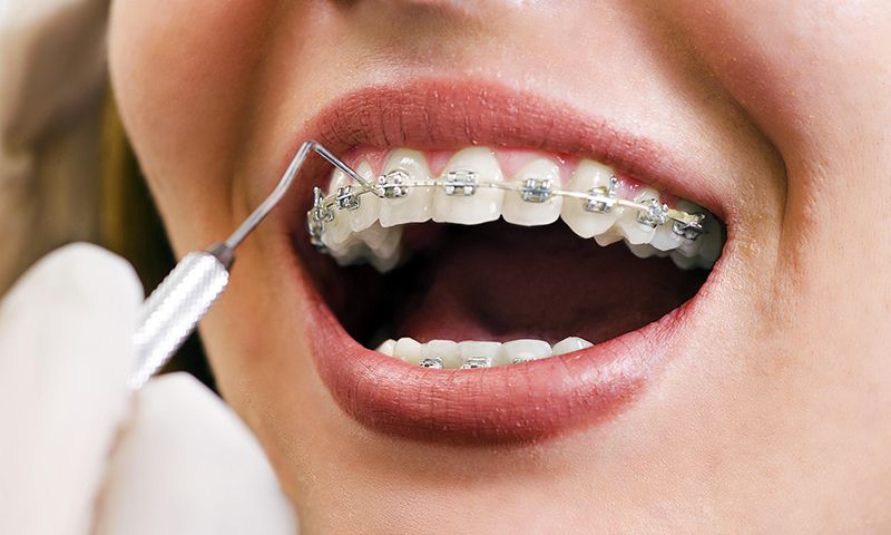 You are currently viewing Dentes Mais Alinhados Podem Melhorar A Saúde Bucal – Aparelho Ortodôntico
