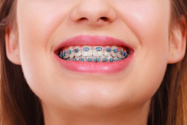 aparelhos dentários