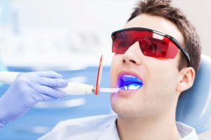Read more about the article Clareamento Dental – Tudo sobre Clareamento Dental