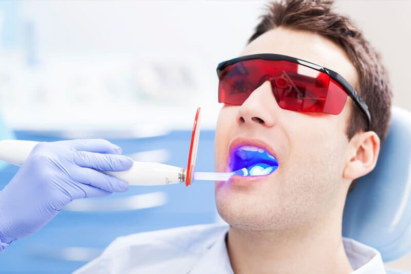 You are currently viewing Clareamento Dental – Tudo sobre Clareamento Dental