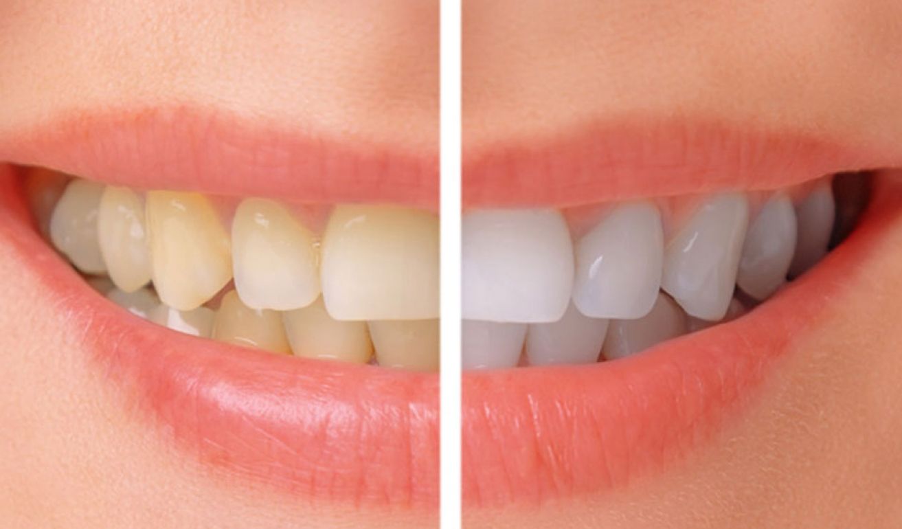 dentes brancos com clareamento